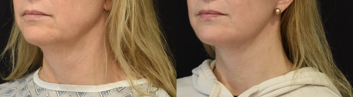 Facelift , Neck Lift Before & After in Cincinnati, Ohio