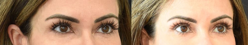 Lateral Temporal Lift (Cincinnati Brow Lift) Before and After