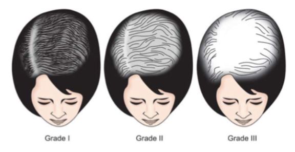 Diagram of Ludwig Classification for Female Patterned Androgenic Alopecia