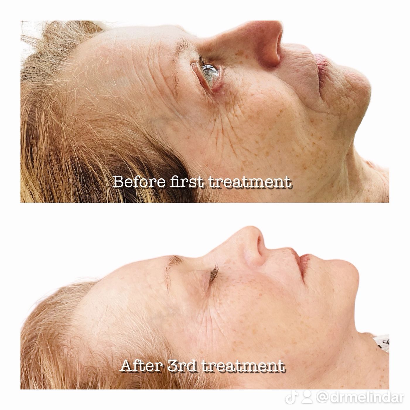 Face & Neck after 3rd Treatment
