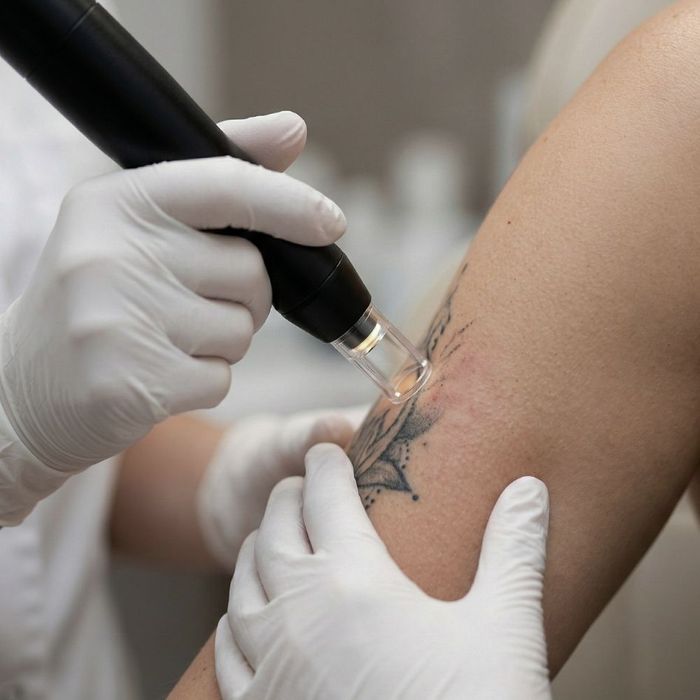 Close-up of a clinical laser treatment being performed on a patient's arm by a professional in white gloves.