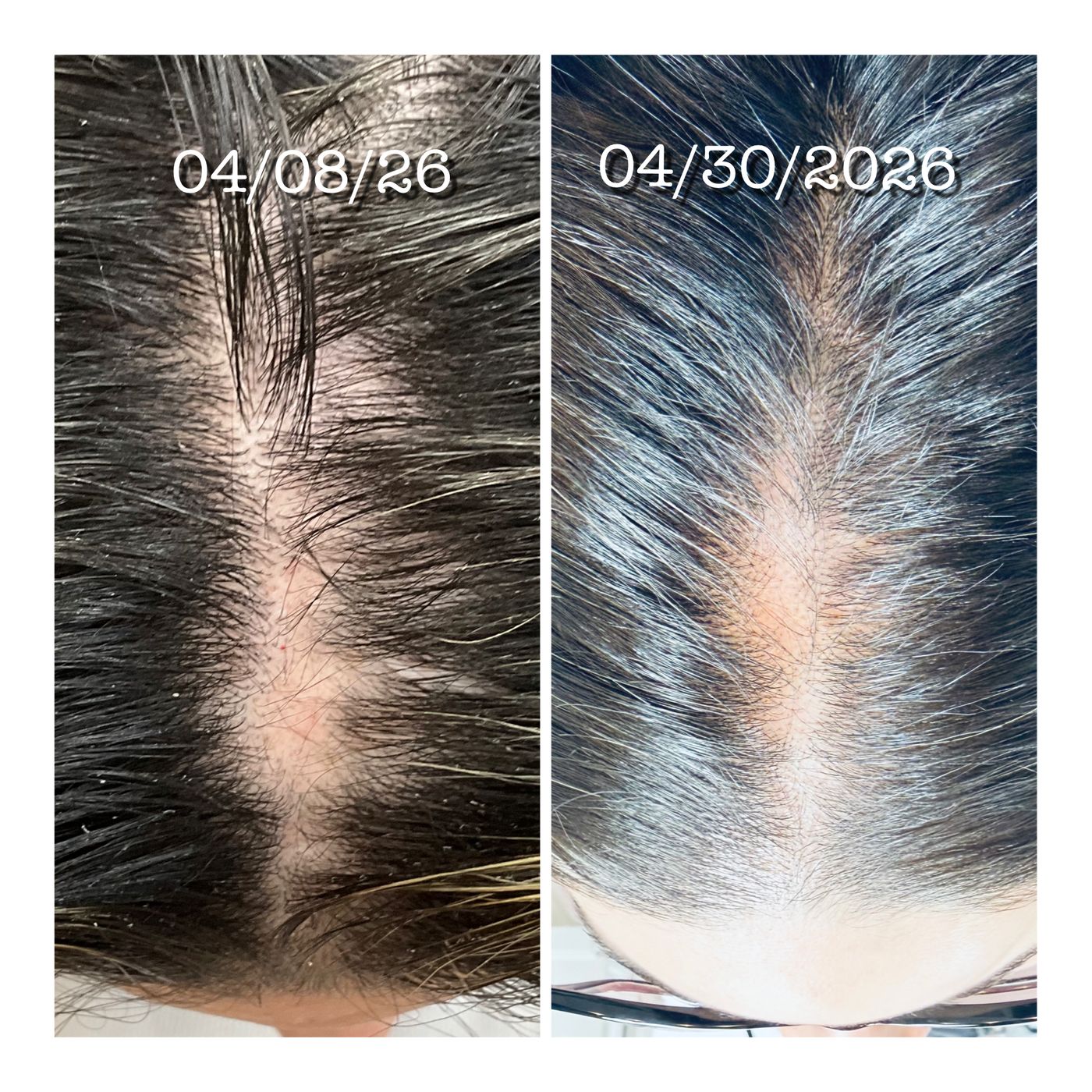 Cold Jet Plasma - Hair Restoration - Needleless, Painless