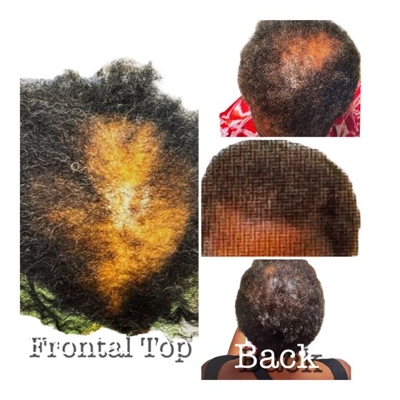 Severe hair loss before treatment, scalp alopecia progression, hair thinning crown area, African American hair loss before PRP treatment