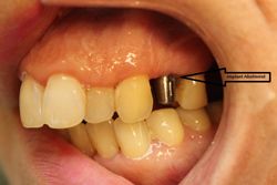 Before dental implant