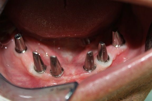 Lower Implant Abutments In Place