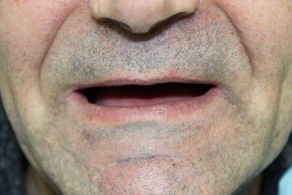 Before: No Upper and Lower Teeth