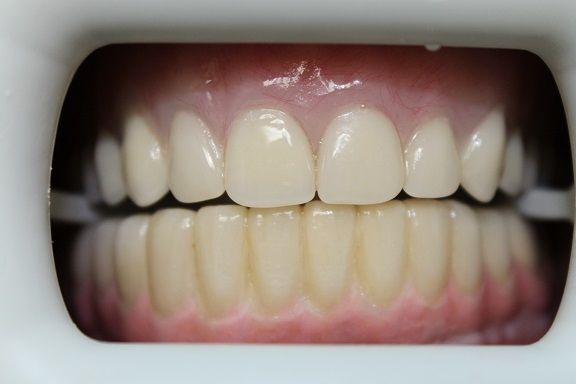 Upper Removable Denture & Lower Fixed Bridge