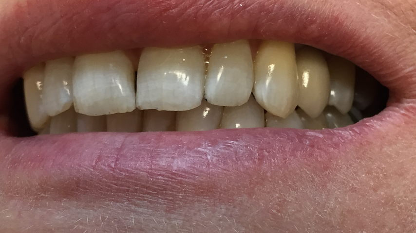 teeth after dental implants
