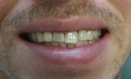 Smile before veneers