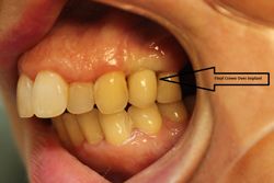 After dental implant