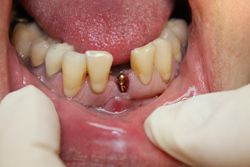 After: Implant in Place