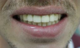 smile after veneers