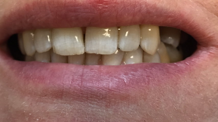 Smile before dental implants