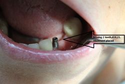 Before dental implant