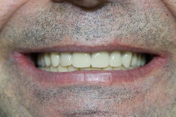 After: Very Happy Patient!!! Job Well Done