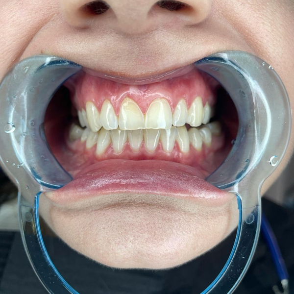 close up of patients teeth in dental office