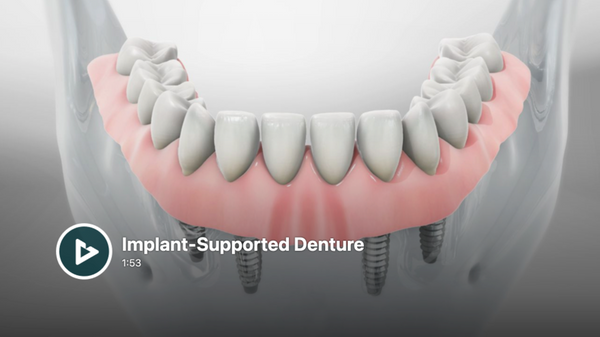 Implant supported Denture.png