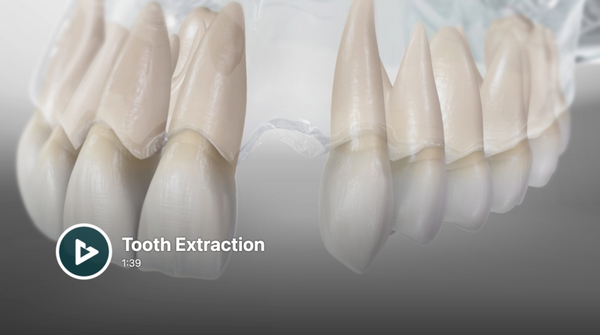 Tooth Extraction.png