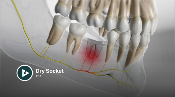 Dry Socket.png