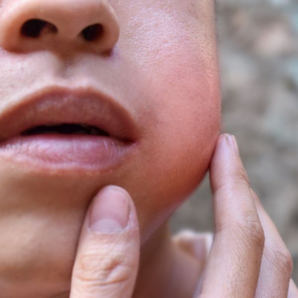 Close-up of swollen cheek with finger pressing against it