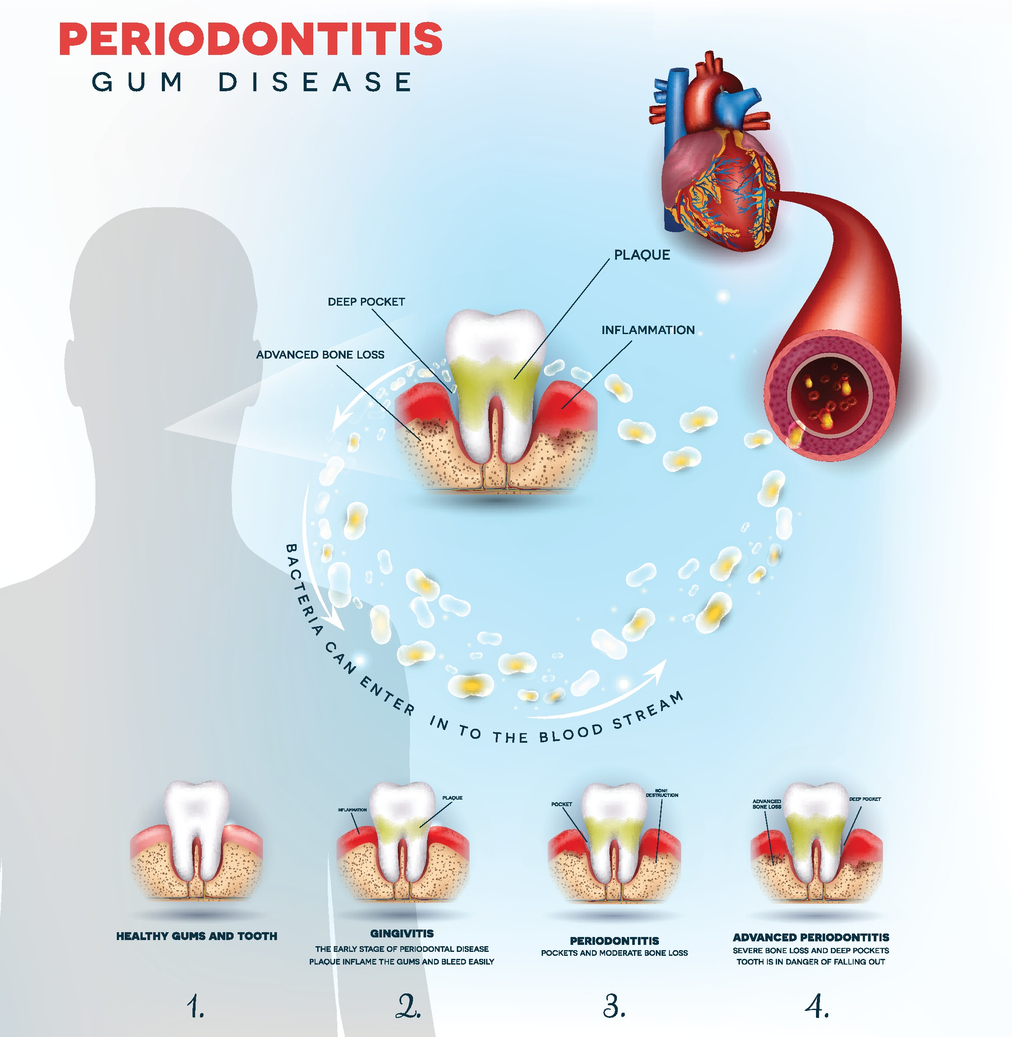 pearl-periodontics-heart-disease-gum-disease.jpg
