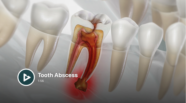 Tooth Abscess.png