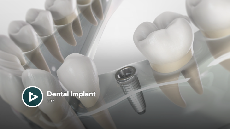 Dental Implant.png