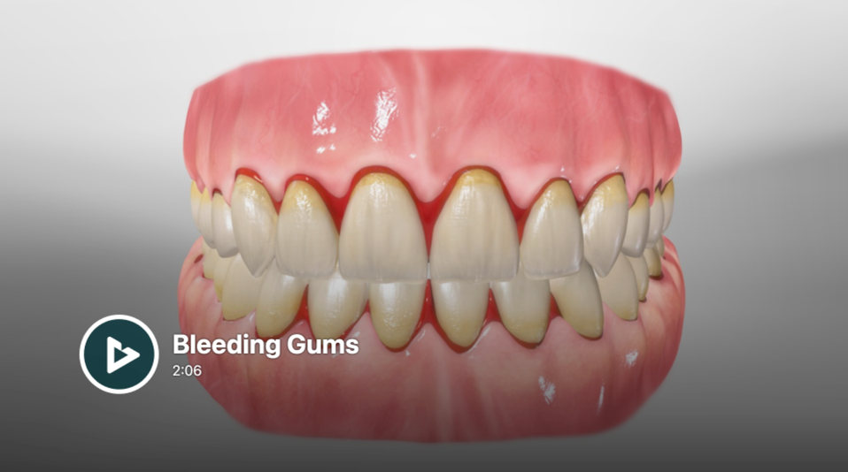 Bleeding Gums.png