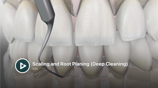Tooth Scaling and Root Planing (Deep Cleaning).png