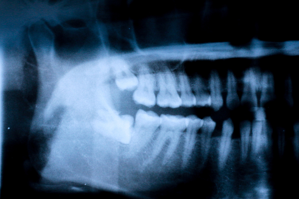 pearl-periodontics-x-rays.jpg