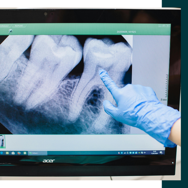 Tooth Extraction 1.png