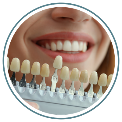 dental veneers