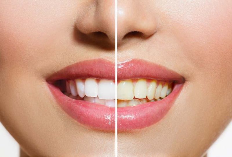 4-Benefits-To-Having-A-Professional-Whiten-Your-Teeth-5d6e6f7347b98-929x628.jpg