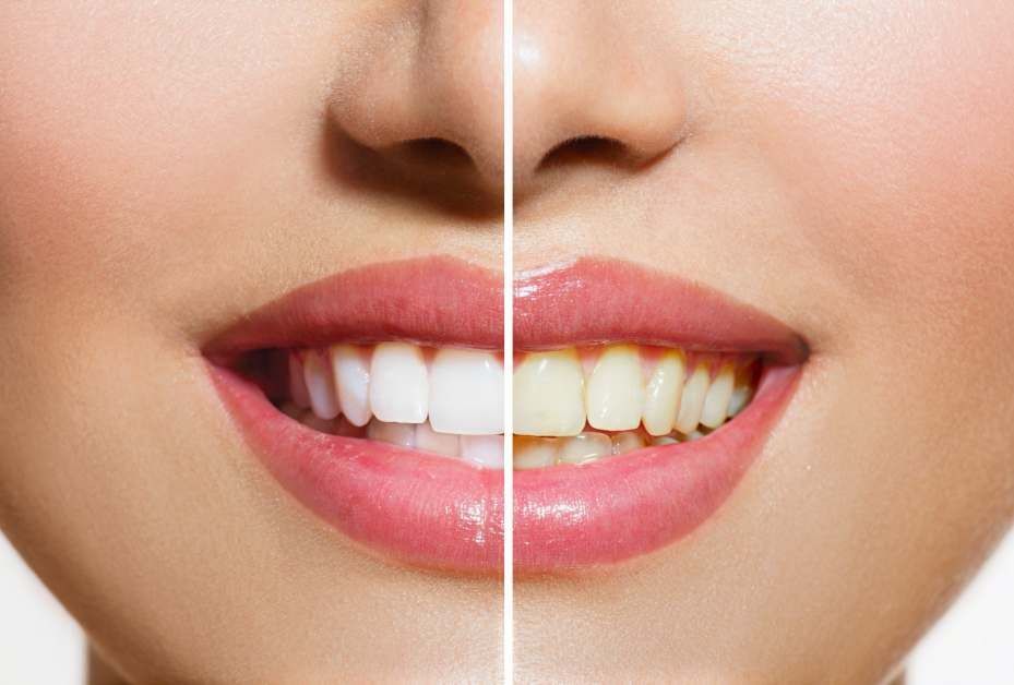 4-Benefits-To-Having-A-Professional-Whiten-Your-Teeth-5d6e6f7347b98-929x628.jpg