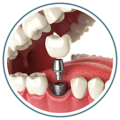 dental implant