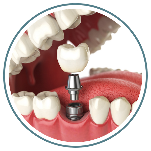 dental implant