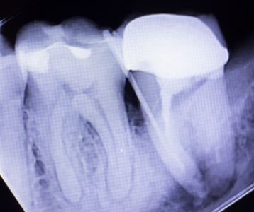 x-ray showing a root canal