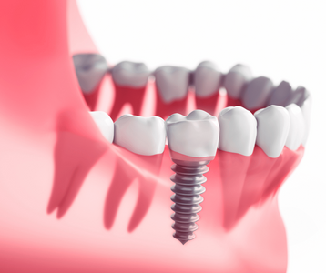 model of dental implant post