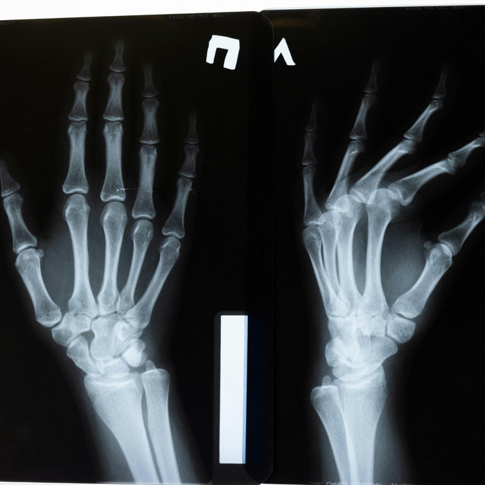 A hand x ray