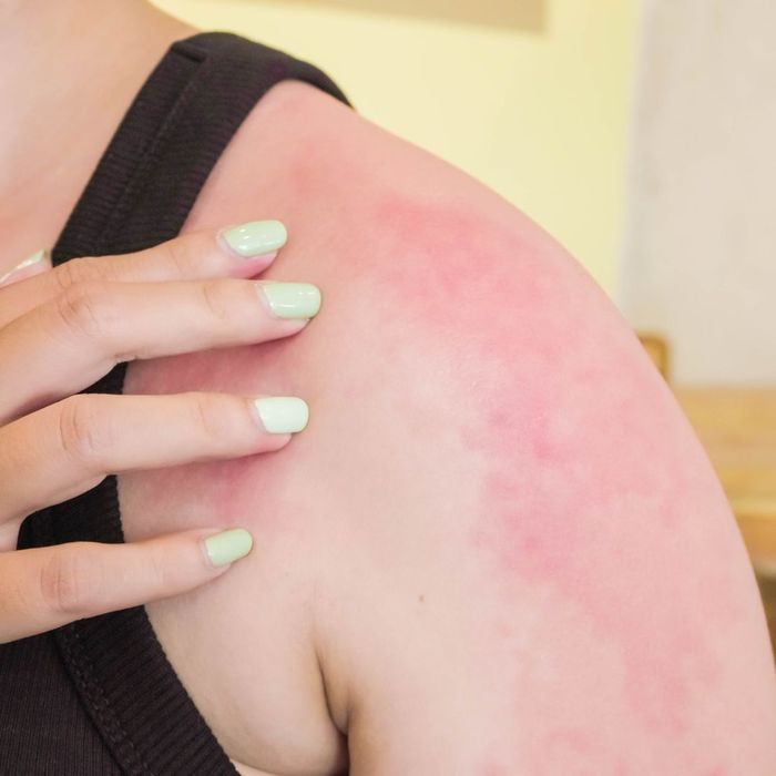 A person with an allergy rash