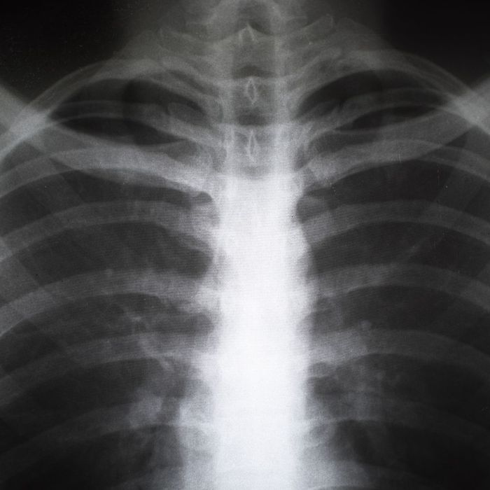 A chest x ray