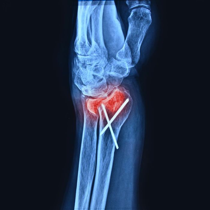 x-ray of fractured bones