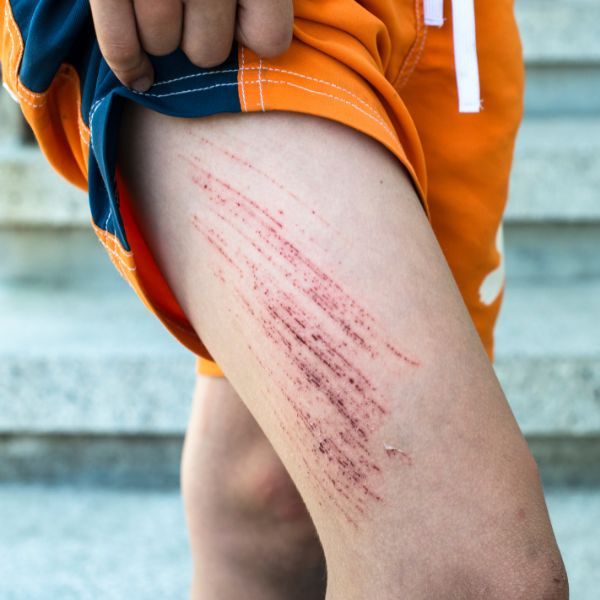 A person with cuts on their leg