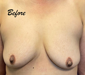 breast lift before