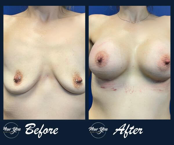 Before and after front view breast augmentation