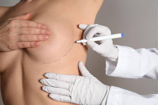 lines being drawn on breasts for augmentation 