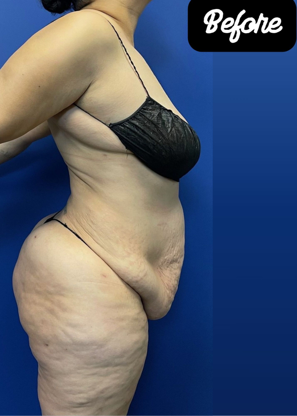 Before Vaser Lipoabdominoplasty Before Vaser LipoAbdominoplasty with Diastasis Repair.jpg