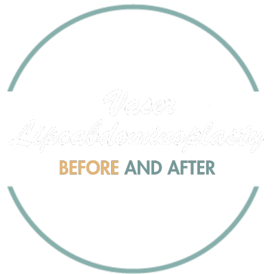 Vaser Lipoabdominoplasty.png