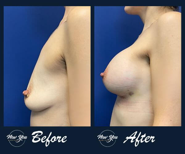 Before and after side view breast augmentation