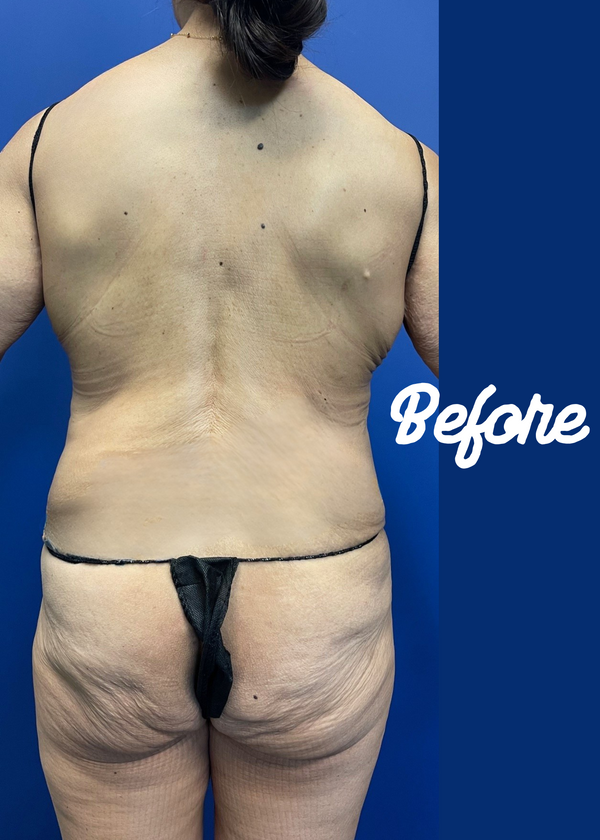 GlutealLift with Vaser Lipocontouring Before & After.png